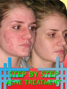 Baixar Step by step acne treatment pdf, epub, eBook