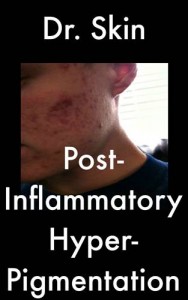 Baixar Post inflammatory hyperpigmentation pdf, epub, eBook