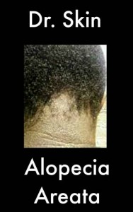 Baixar Alopecia areata pdf, epub, eBook