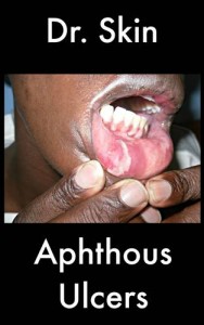 Baixar Aphthous ulcers pdf, epub, eBook