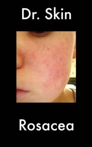 Baixar Rosacea pdf, epub, eBook