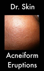 Baixar Acneiform eruptions pdf, epub, eBook